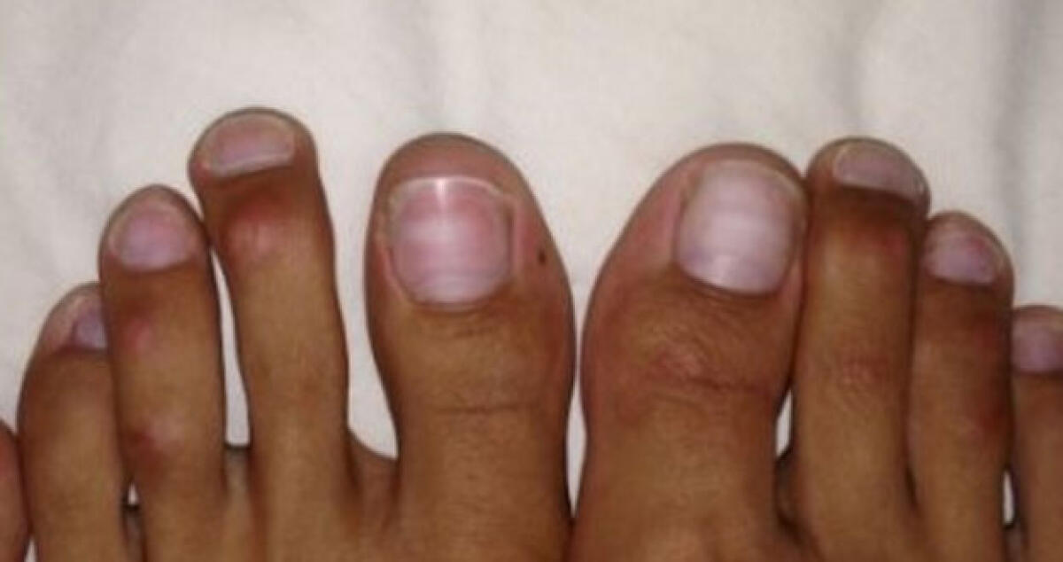 Dita dei piedi tagliate e accorciate per indossare meglio i tacchi. La nuova richiesta al chirurgo - 