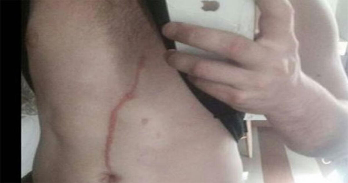 Si sveglia con una strana scia sullo stomaco e scopre che un ragno si è rifugiato nel suo corpo - 