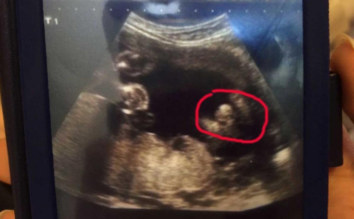 Ginecologo sbaglia la diagnosi, invece di un maschietto nasce una femminuccia - L'ecografia che ha tratto in errore il ginecologo. In rosso quello che sarebbe dovuto essere il sesso del bimbo.