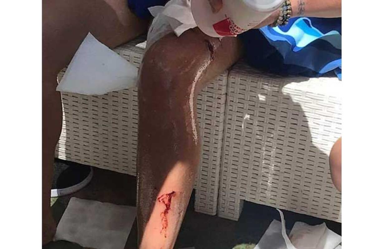 Donna aggredita da randagi a Macchitella, Iudice: Si dimetta il sindaco - Le ferite alla gamba riportate dalla malcapitata
