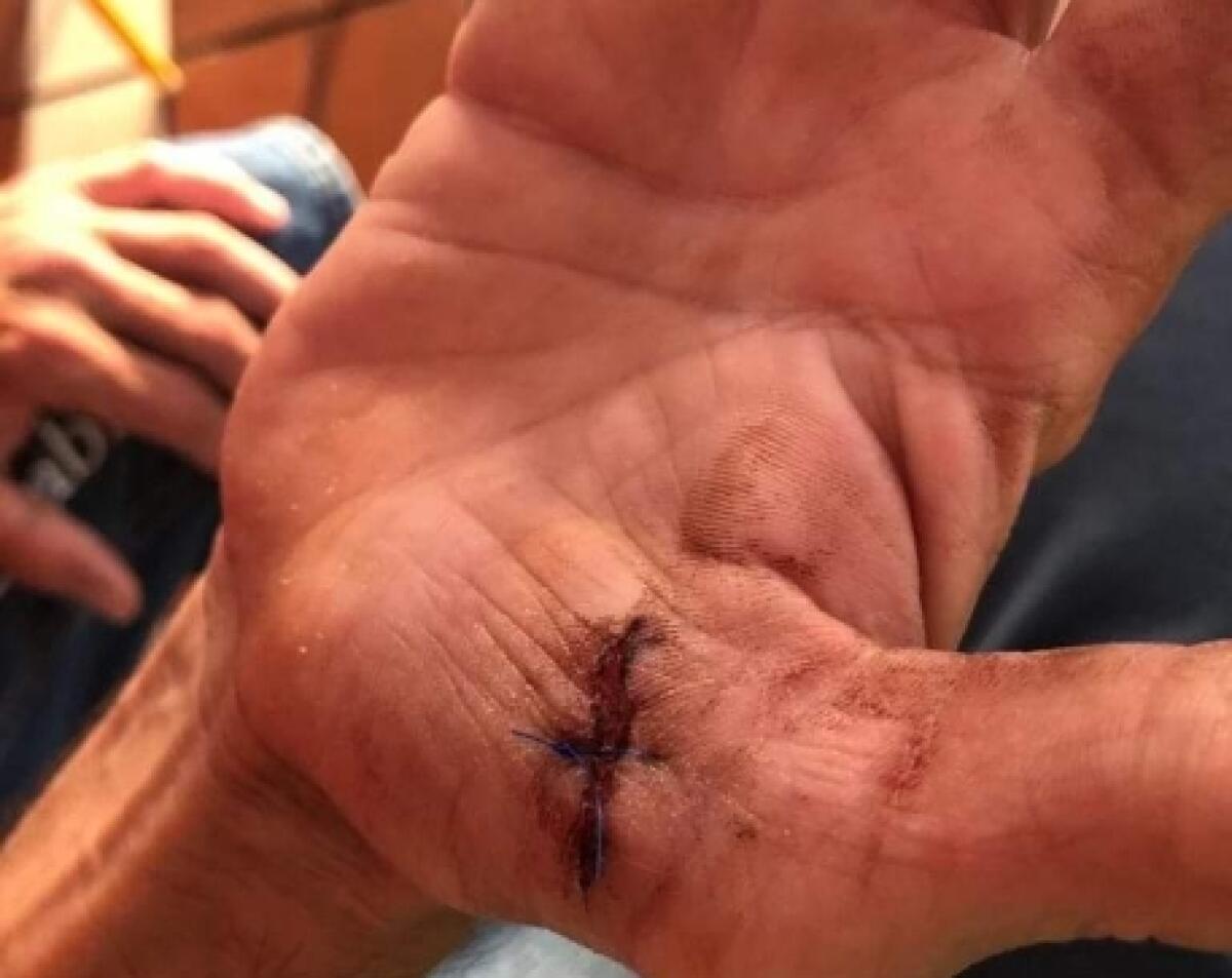 Azzannato in viale Indipendenza da due randagi, quarantaseienne finisce in ospedale - Una delle profonde ferite riportate dall'uomo