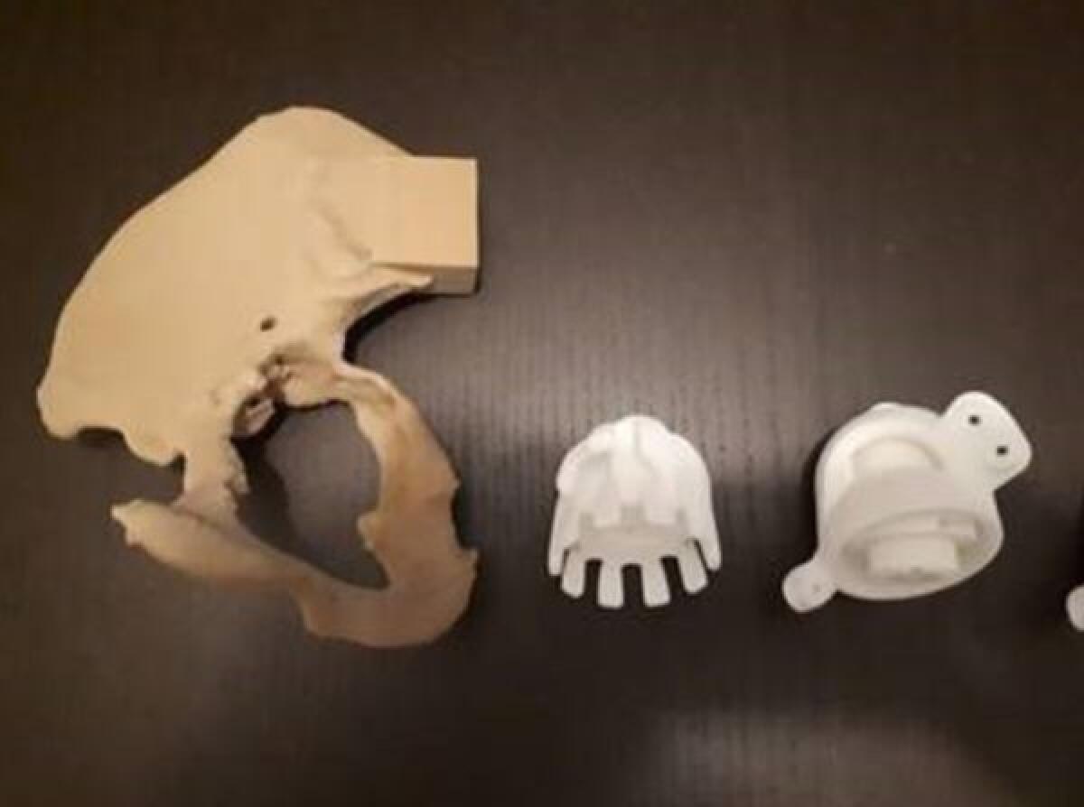 Protesi all’anca in 3d impiantata a Ferrara - 