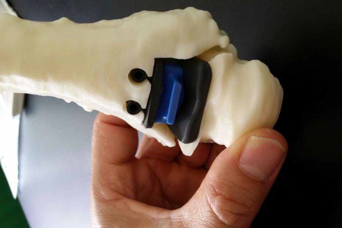 CAVIGLIA RICOSTRUITA IN 3D AL RIZZOLI DI BOLOGNA -