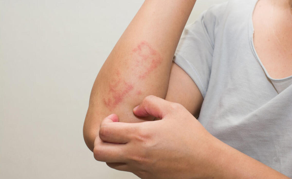 Psoriasi, un corto per superare vergogna, depressione e isolamento - 
