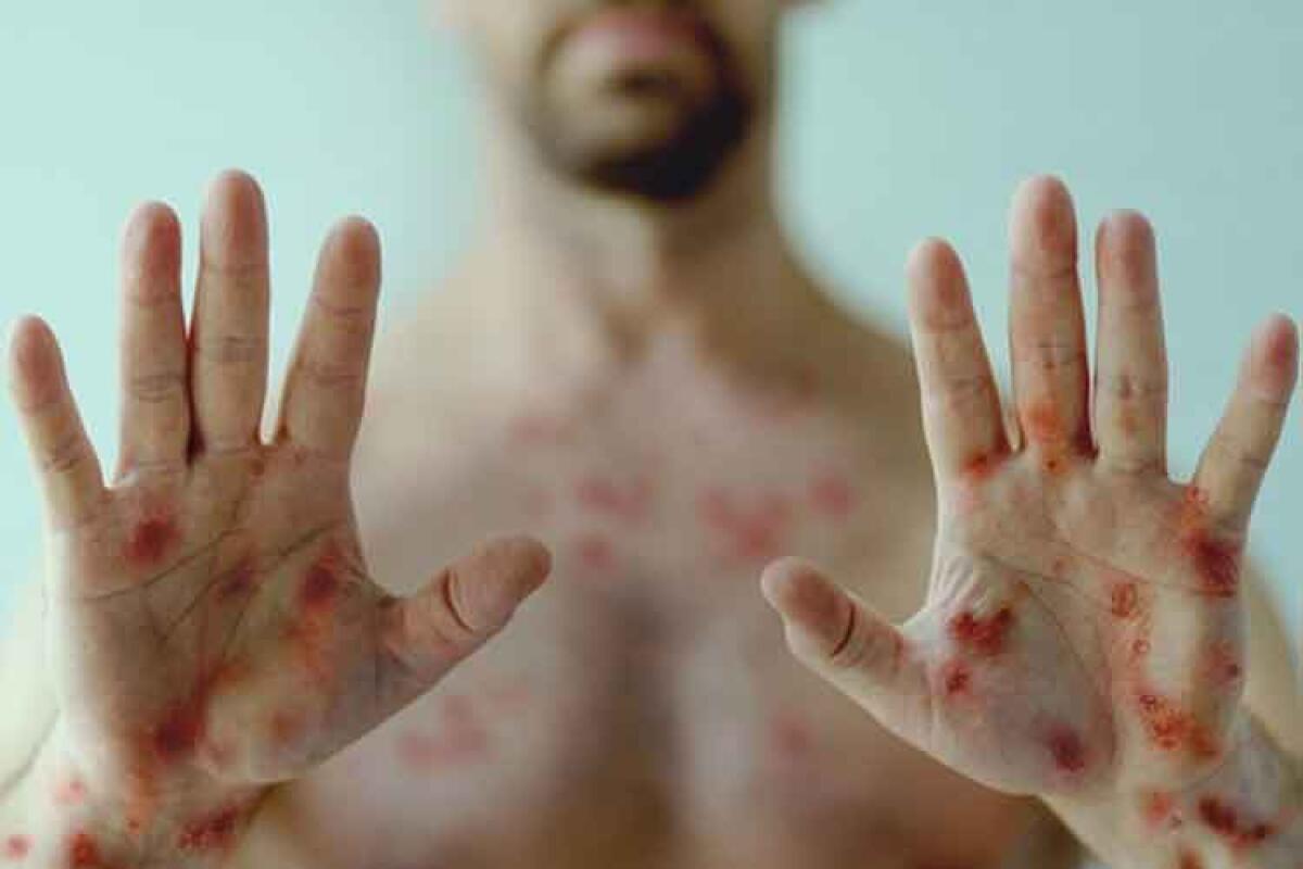 Caso sospetto di vaiolo delle scimmie, il paziente: "l'ospedale non è organizzato" - Immagine simbolica del vaiolo delle scimmie