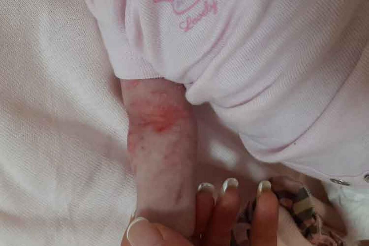 Bimba di 2 mesi positiva al covid, il papà: “Ignorati dall’Usca e maltrattati in ospedale” - Nella foto grande: il braccino della bimba di 2 mesi dopo i tentativi del personale ospedaliero di prenderle una vena.