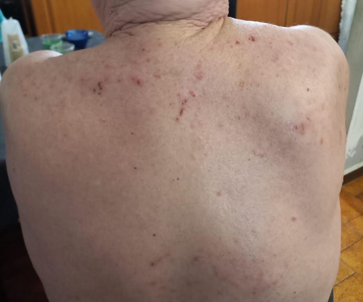 Accertamenti su un anziano, "ha contratto la scabbia", familiari: "Era ospite di una struttura privata" - L'anziano già presentava i segni del contagio da scabbia