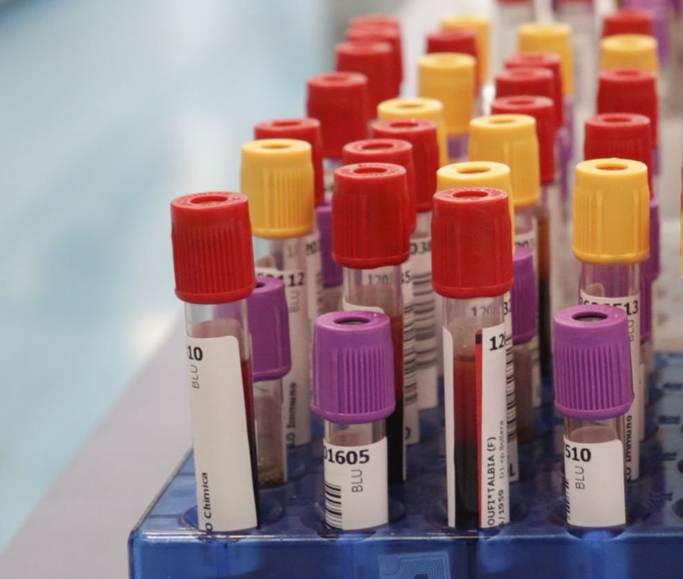 Botulino, dal 2001 al 2024 segnalati 1.276 casi in Italia - 