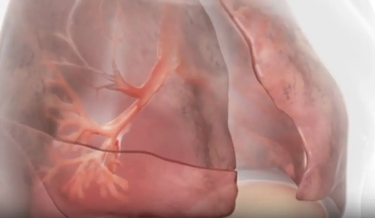 Innovazioni terapeutiche nella BPCO con enfisema - 