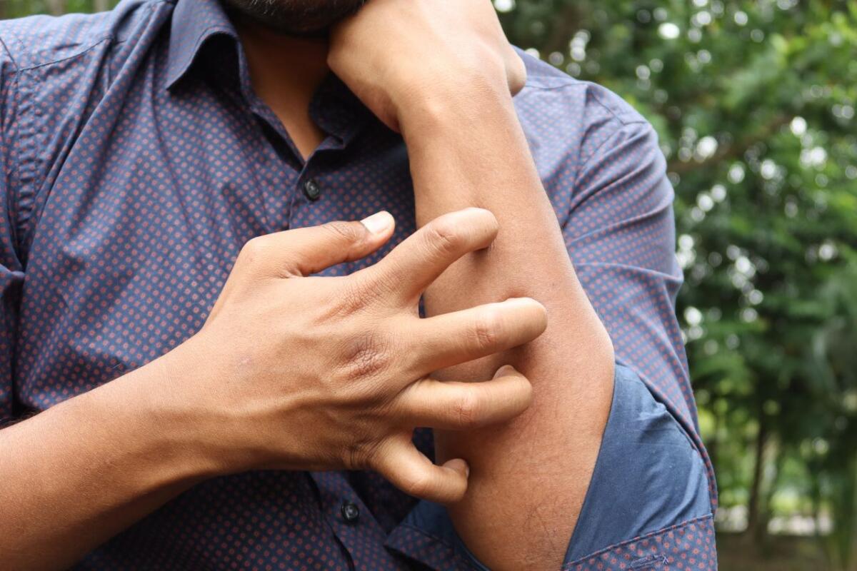 Studio Novartis, l’orticaria cronica spontanea costa 4.200 euro l’anno a paziente - 